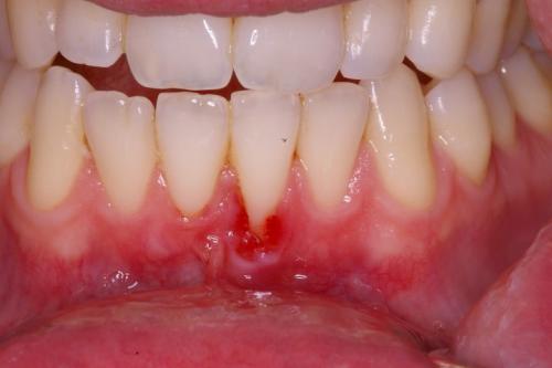 Connective Tissue Graft