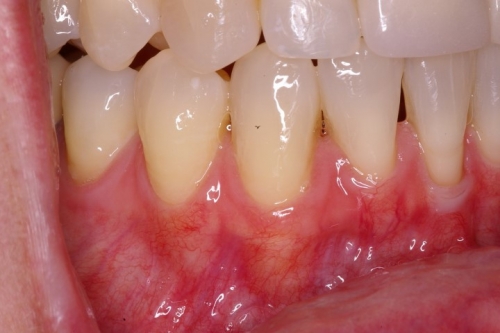 Gingival Grafts on the Lower Anterior