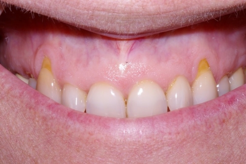 Lateral Sliding Flap