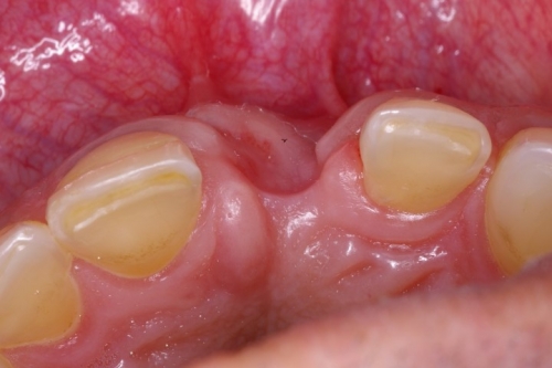 Ridge Augmentation in the Anterior