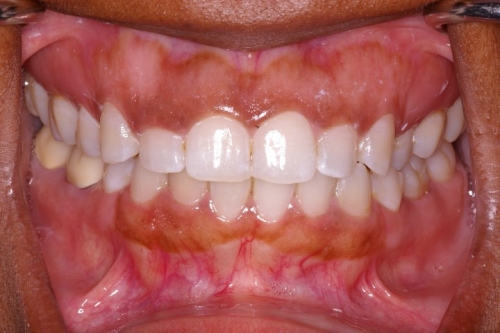 Smile Alignment and Crown Lengthening