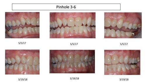 Pinhole before and afters Stuart 1 -34